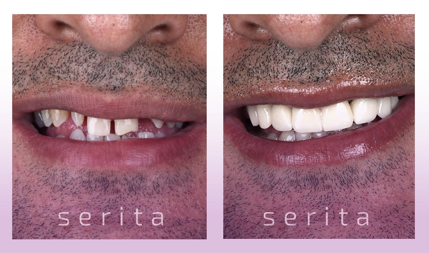 نمونه کار لمینت دندان کلینیک سریتا همراه با مراحل لمینت دندان به همراه فیلم