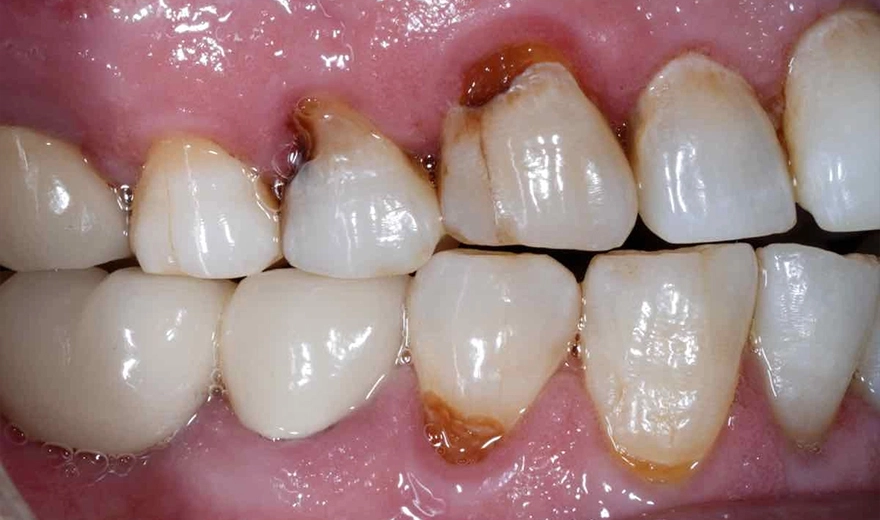 دندان پوسیده باعث خرابی کامپووزیت دندان می شود.