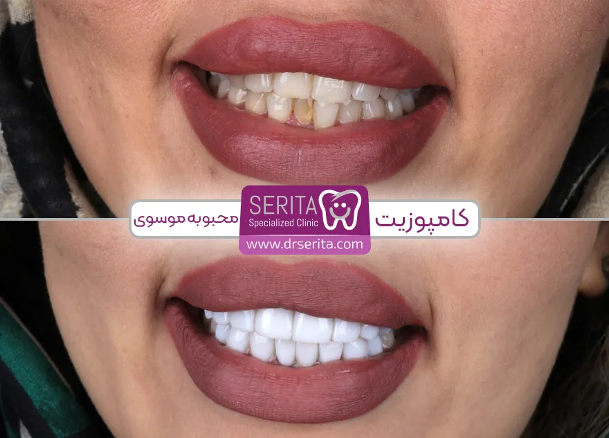 نمونه کار کامپوزیت دندان قبل و بعد کلینیک سریتا محبوبه موسوی