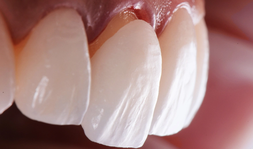 طول عمر و ماندگاری لمینت دندان خصوصا برای دندان کج