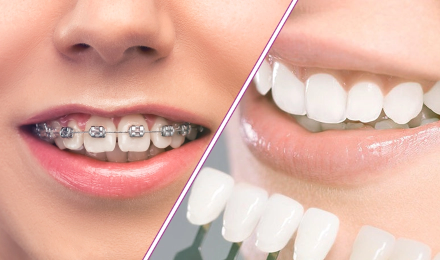 روش های درمان دندان کج با کامپوزیت و ازتودنسی و لمینت