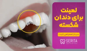 مزایا و معایب لمینت دندان شکسته