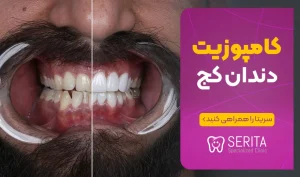 کامپوزیت برای دندان های کج