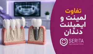 تفاوت لمینت و ایمپلنت دندان چیست؟ مقایسه کامل دو درمان