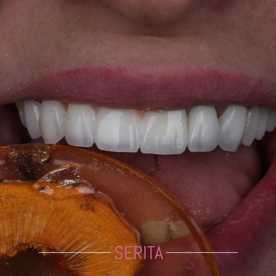 عکس نمونه کار ایمپلنت دندان