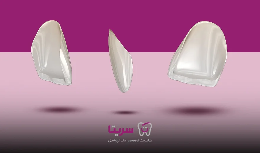 طرح سه بعدی از لمینت دندان کلینیک سریتا
