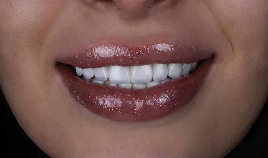افزایش طول عمر لمینت دندان با مراقبت های بهداشت دهان و دندان