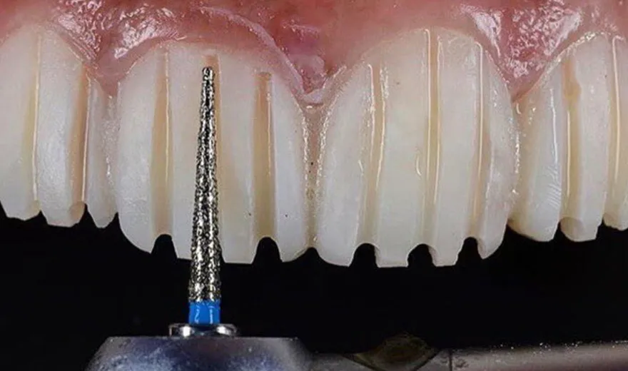 تراش دندان قبل از  لیمنت دندان یکی از عوارض آن است
