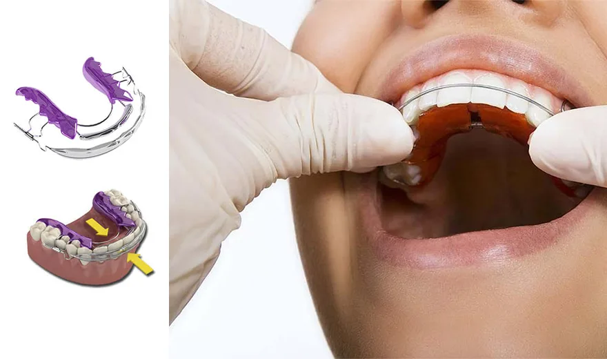 ارتودنسی متحرکت دندان و عوارض و معایب آن