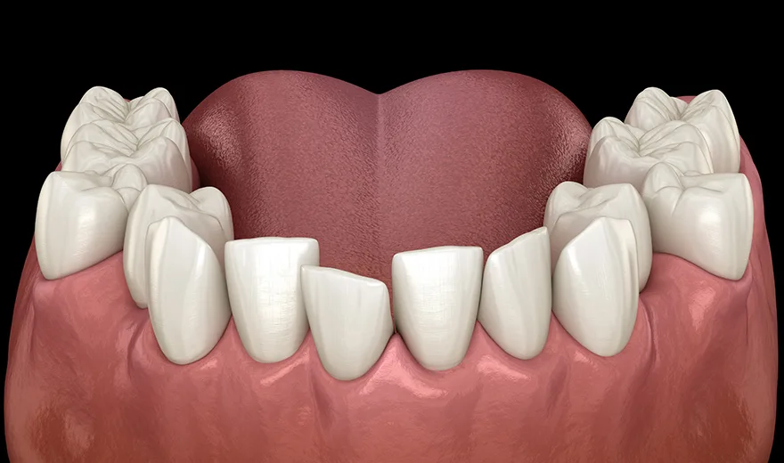 مشکلاتی که دندان نیش بیرون زده ایجاد می کند