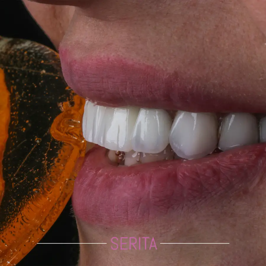عکس نمونه کار ایمپلنت دندان
