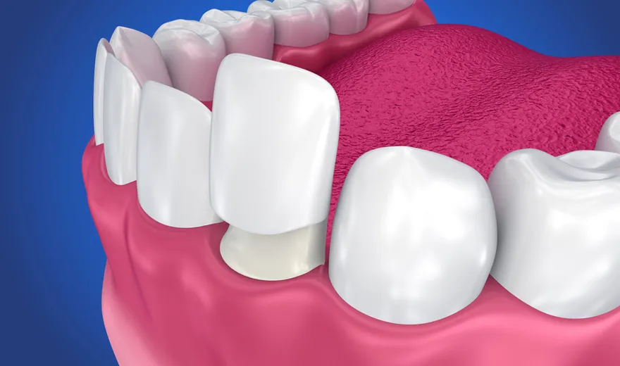 کامپوزیت دندان و تفاوت در مراقب با روکش دندان