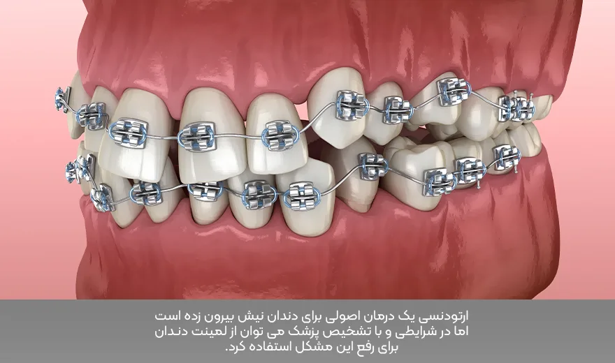 درمان اصلی برای دندان نیش بیرون زده ارتودنسی دندان است اما در مواردی می توان از لمینت دندان هم استفاده کرد.