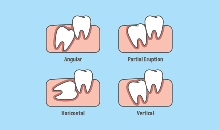 انواع مختلف دندان عقل نهفته: مزیال، دیستال، عمودی، افقی