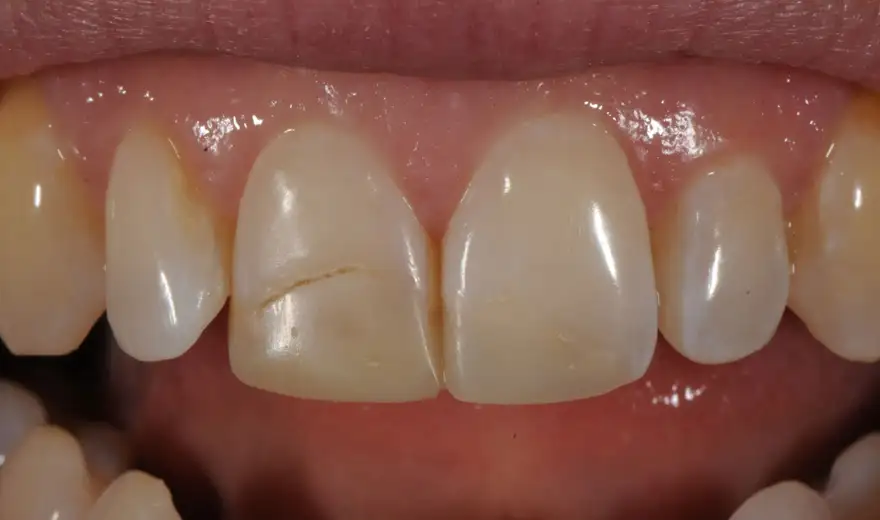 عوارض بعد از لمینت دندان