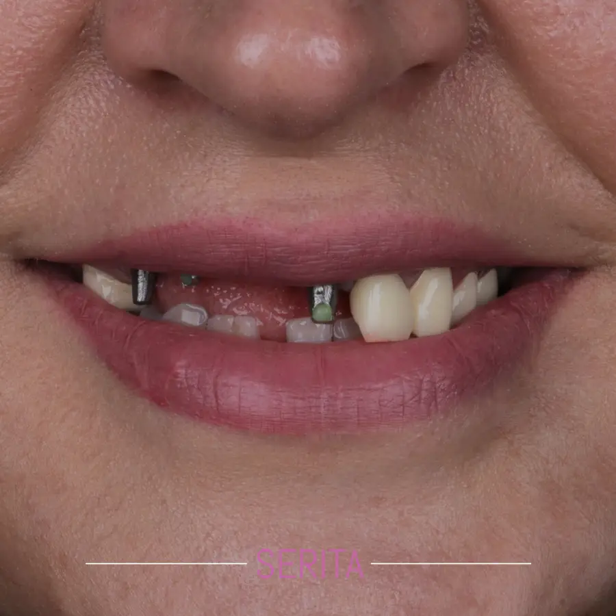 عکس قبل از ایمپلنت دندان جلو