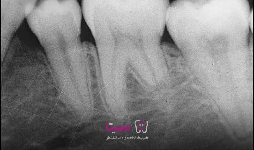 کوتاه شدن و تحلیل ریشه دندان بر اثر ارتودنسی
