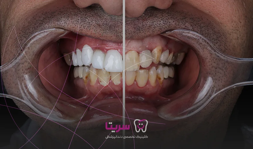 قبل و بعد لمینت دندان فک بالا در کلینیک سریتا