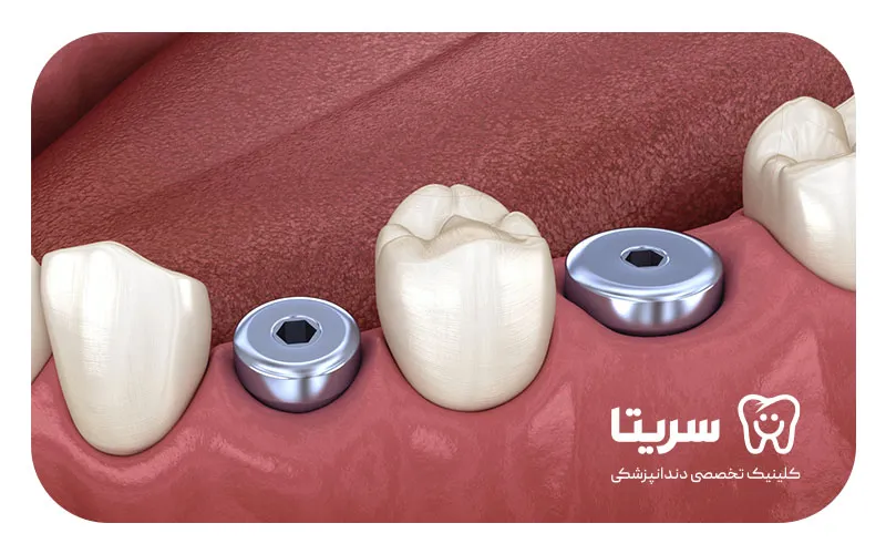 هیلینگ ایمپلنت داخل لثه و دهان