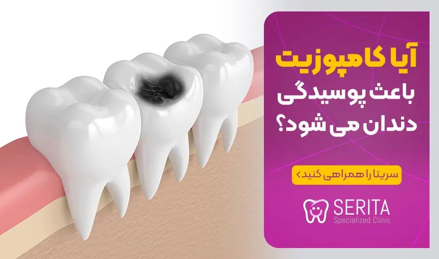 آیا کامپوزیت باعث پوسیدگی دندان می شود؟