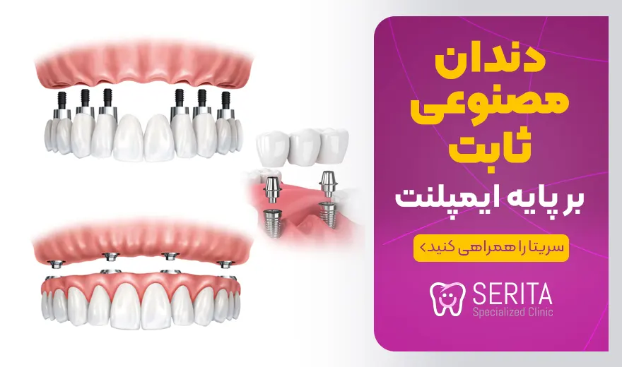 انواع دندان مصنوعی ثابت بر پایه ایمپلنت