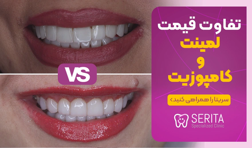 تفاوت قیمت لمینت و کامپوزیت دندان