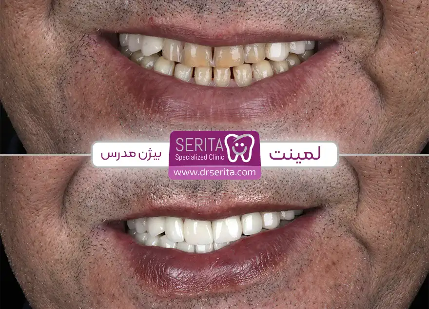 قبل و بعد ترمیم لمینت دندان در کلینیک سریتا آقای بیژن مدرس