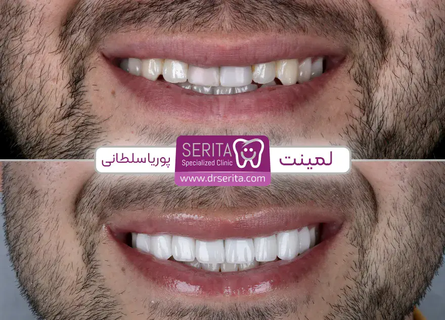 قبل و بعد لمینت دندان در کلینیک سریتا اقای پوریا سلطانی