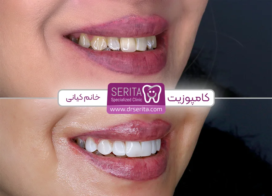 قبل و بعد از انجام کامپوزیت دندان در کلینیک سریتا خانم کیانی
