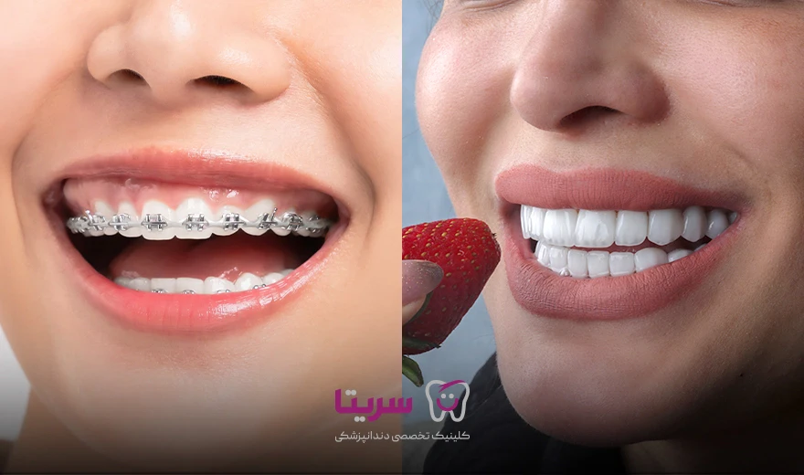 تفاوت و مقایسه کامپوزیت دندان با ارتودنسی دندان