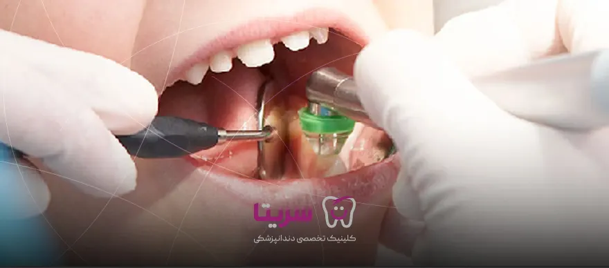 ازون تراپی در دندانپزشکی چیست؟
