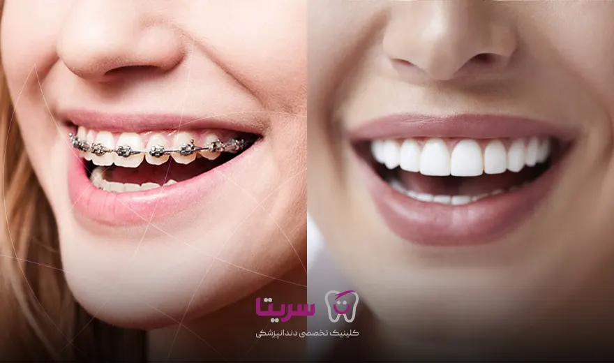 مقایسه ارتودنسی و لمینت دندان