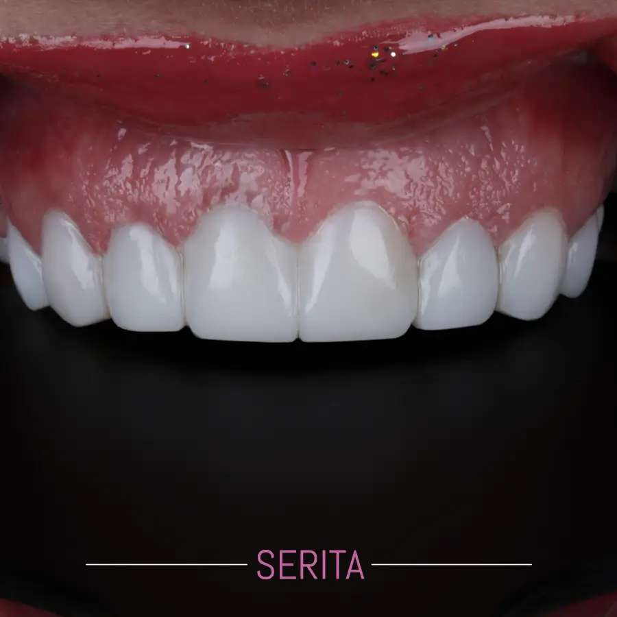 قبل و بعد کامپوزیت دندان