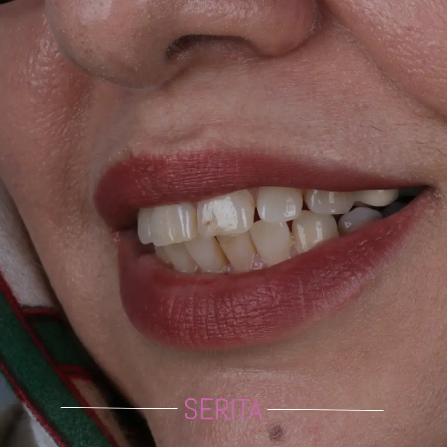 نمونه کار کامپوزیت دندان و قبل و بعد کامپوزیت