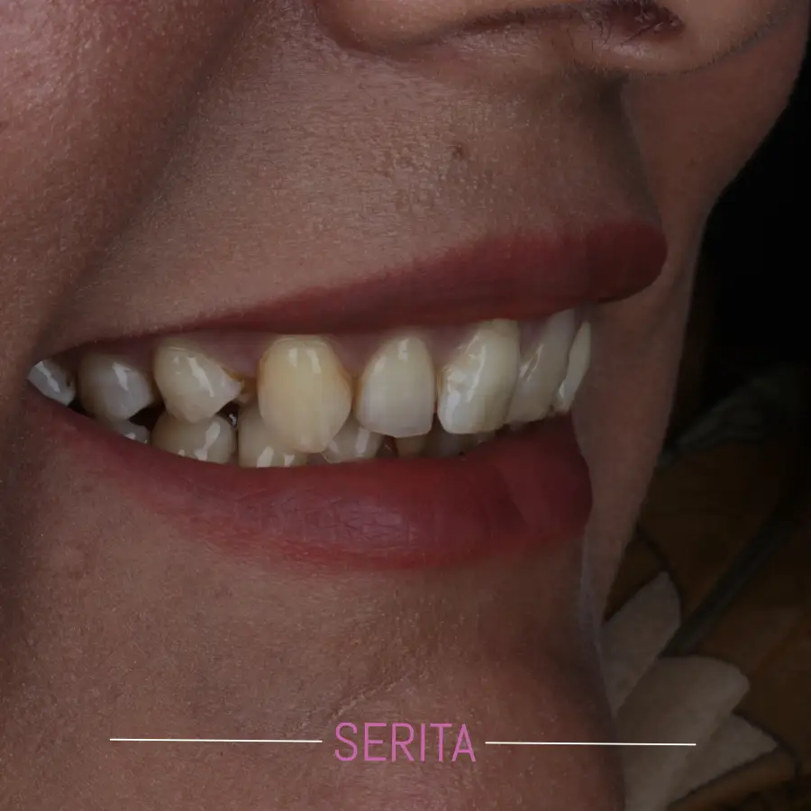 قبل و بعد از انجام کامپوزیت دندان