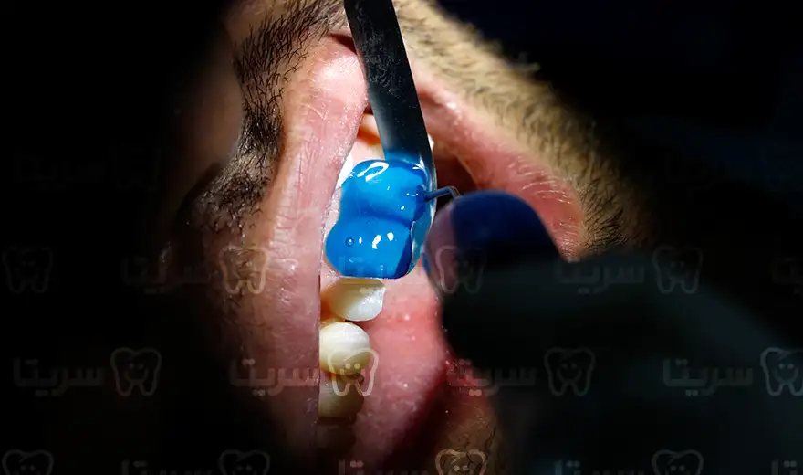 کامپوزیت دندان مرحله اسید شویی