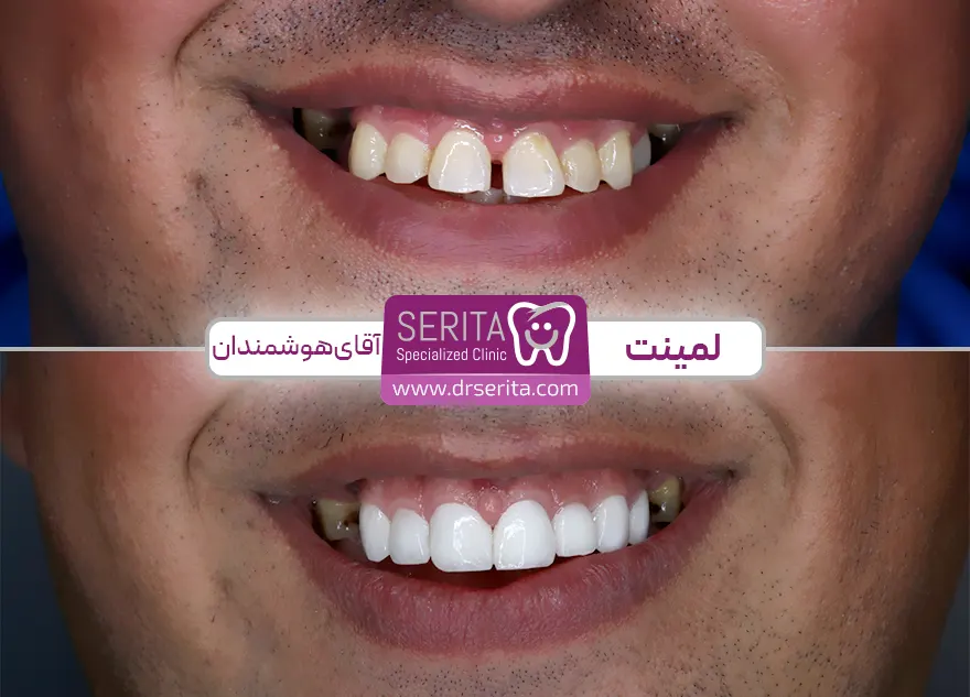 عکس نمونه کار لمینت دندان در کلینیک سریتا