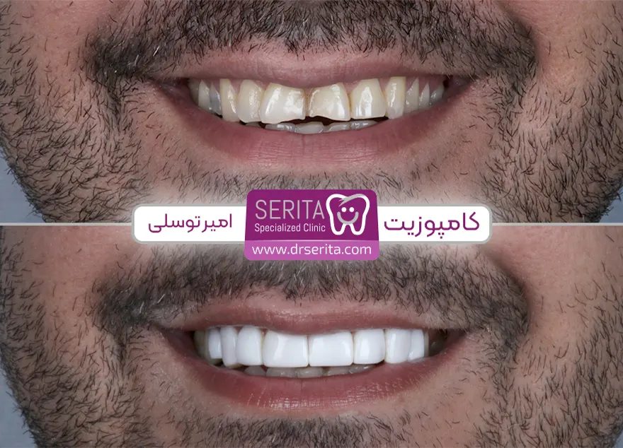 نمونه کار و قبل و بعد کامپوزیت دندان شکسته در کلینیک سریتا