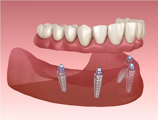 ایمپلنت دندان all on 4 در ایمپلنت کل دندانها