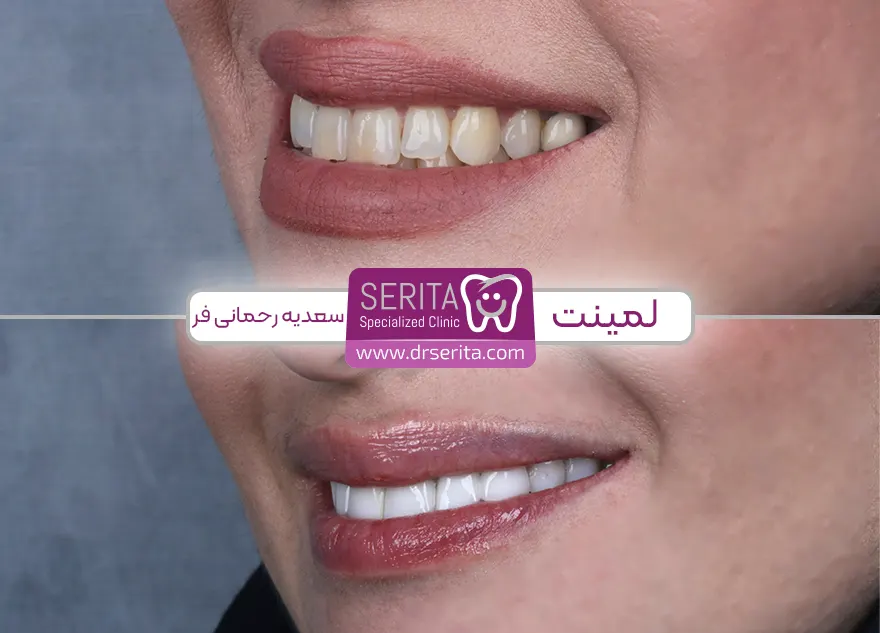 قبل و بعد لمینت دندان در تهران