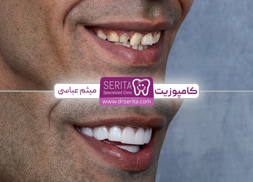 نمونه کامپوزیت برای دندان کج
