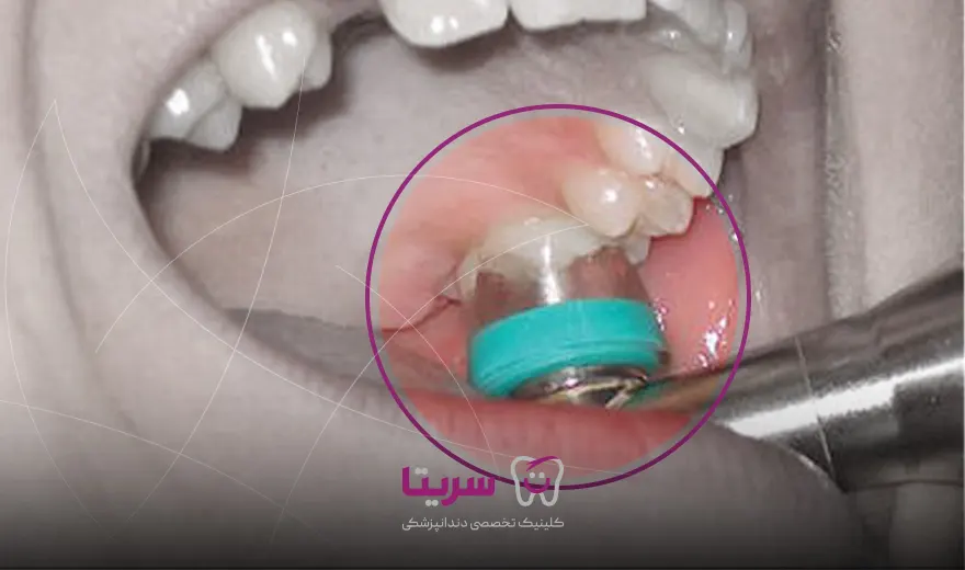 ازون تراپی در دندانپزشکی