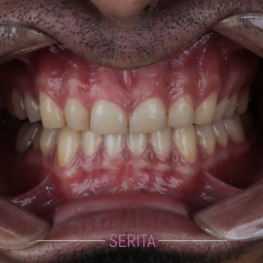 قبل و بعد لمینت دندان
