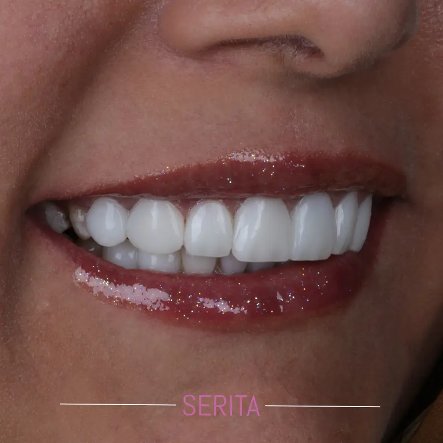 قبل و بعد از انجام کامپوزیت دندان