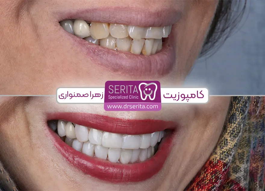 قبل و بعد کامپوزیت دندان کج در کلینیک سریتا