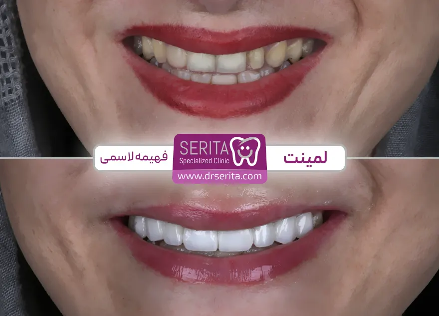 لمینت دندان کلینیک سریتا قبل و بعد