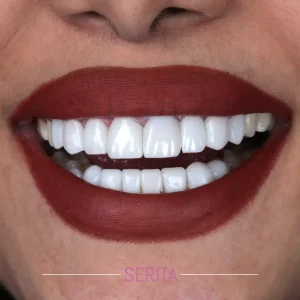 نمونه کار کامپوزیت دندان کلینیک سریتا