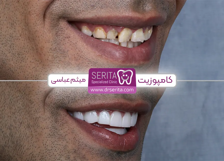 نمونه کار و قبل و بعد کامپوزیت دندان شکسته جلو در کلینیک سریتا