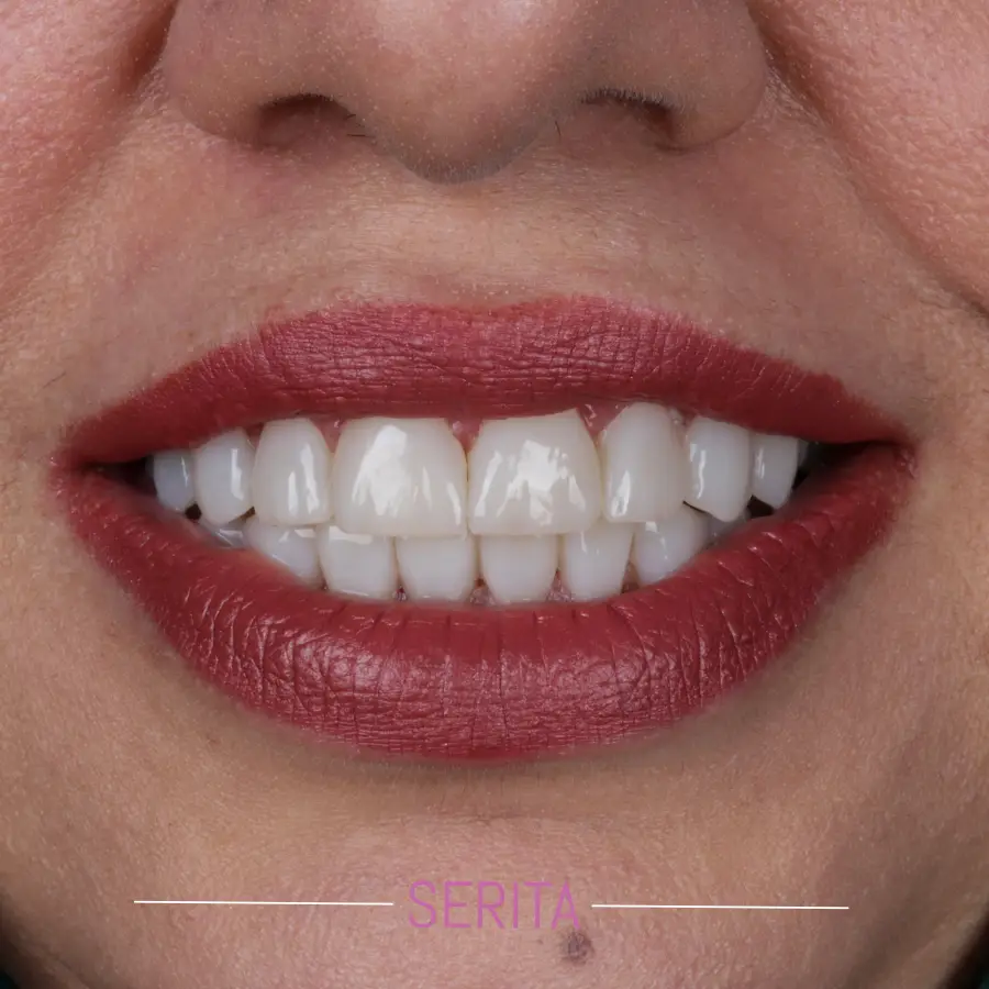نمونه کار کامپوزیت دندان و قبل و بعد کامپوزیت