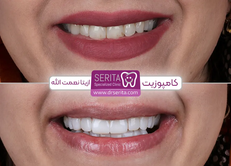 کامپوزیت دندان - قبل و بعد کامپوزیت دندان در کلینیک سریتا